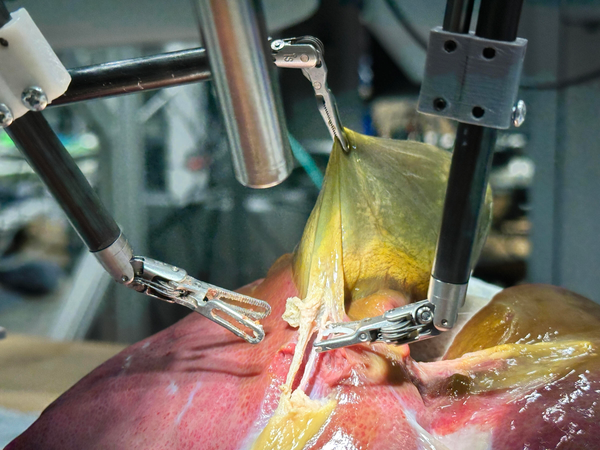 This AI Robot Just Performed Surgery on Its Own (And It Was Flawless)